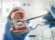 a dentist explains the dental implant procedure and dental implant options after a patient asks what are dental implants