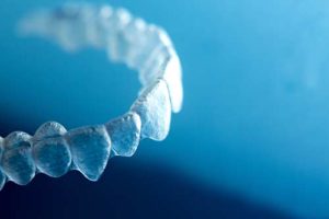 example of clear aligners