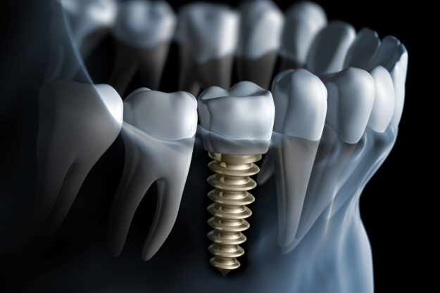 What is a Single Tooth Implant (4) example of a single tooth implant