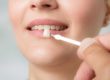 dentist fitting patient for dental veneers