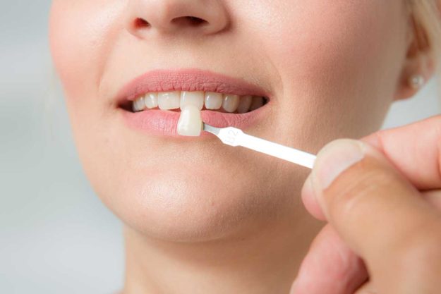 5-Benefits-of-Dental-Veneers dentist fitting patient for dental veneers