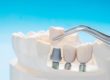 dental implants being placed
