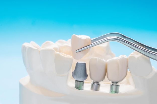 How-Do-Dental-Implants-Work dental implants being placed